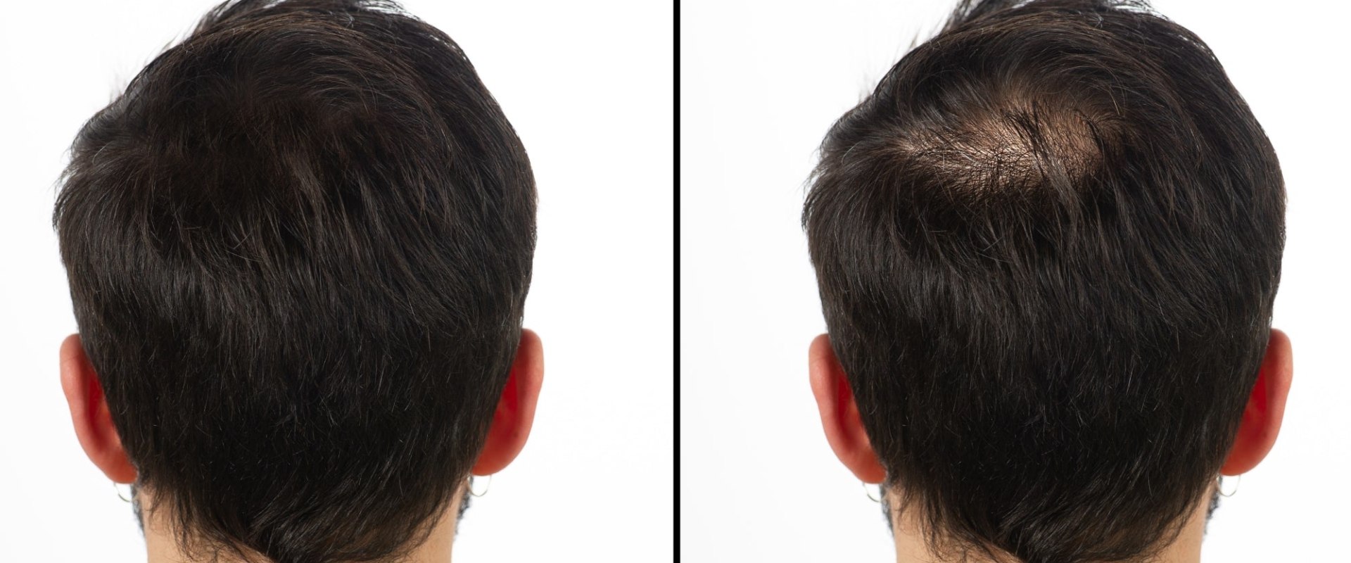 Understanding Finasteride: A Comprehensive Overview for Hair Loss Treatment