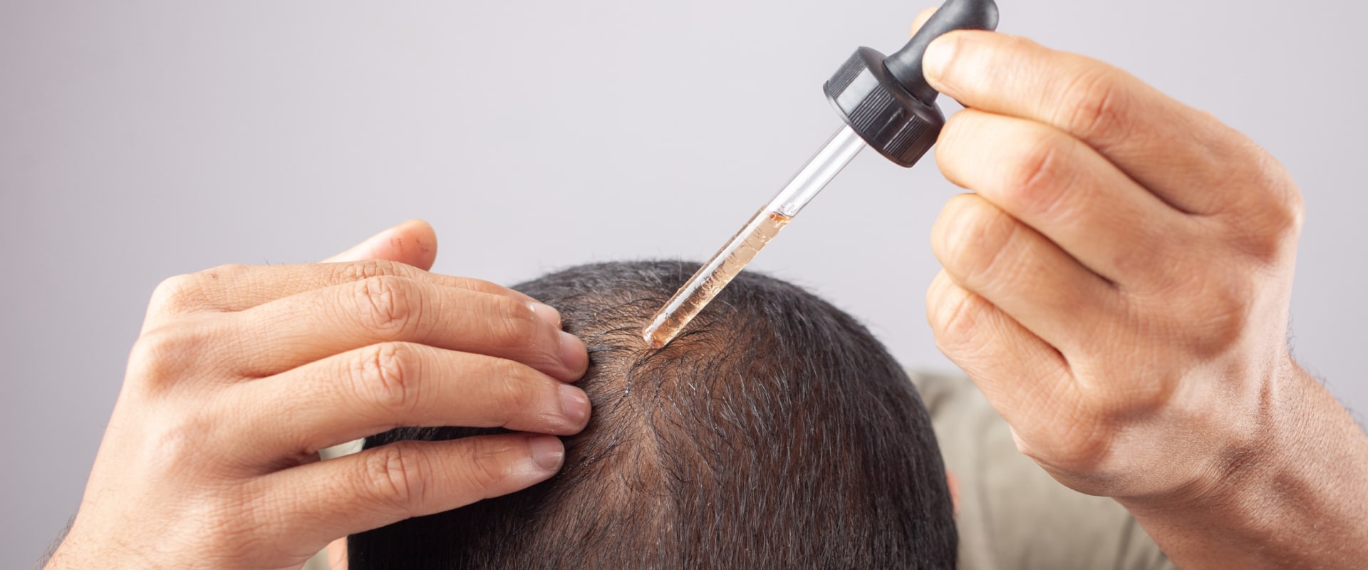 All You Need to Know About Minoxidil: A Comprehensive Guide for Hair Loss Treatment