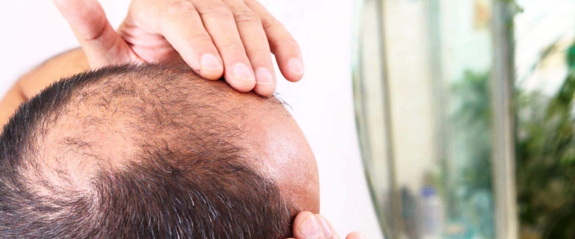 How to Treat Male Pattern Baldness