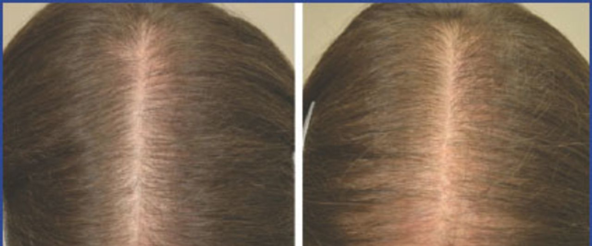 Understanding Medical Treatments for Female Hair Loss