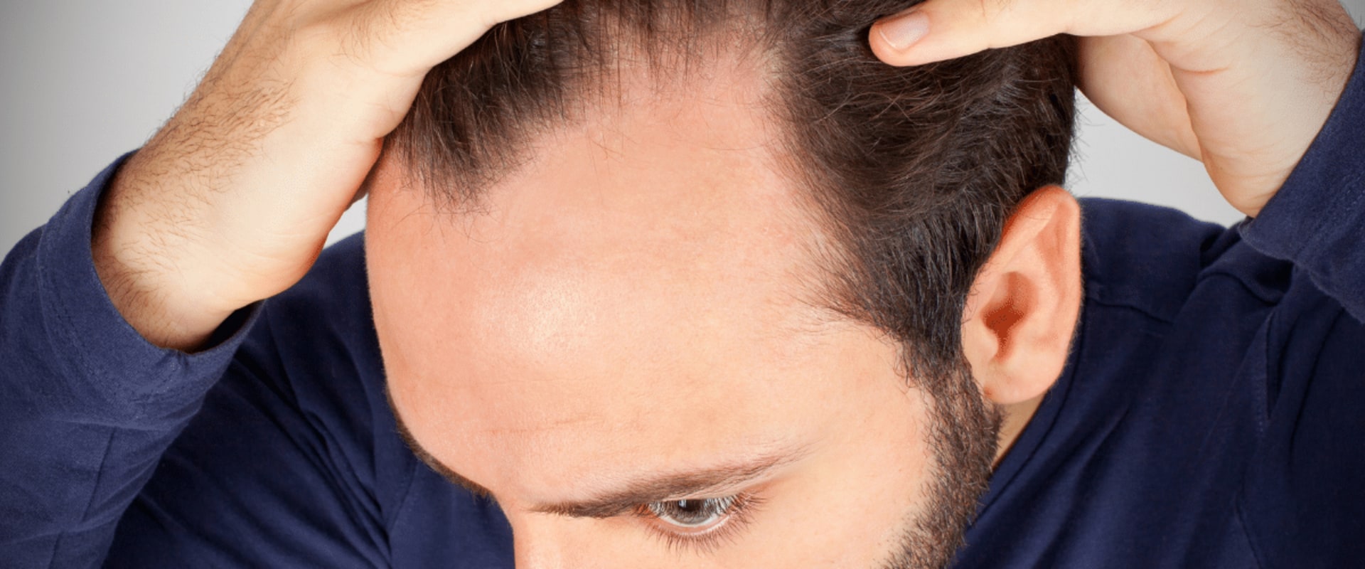 Hormonal Changes and Male Pattern Baldness: A Comprehensive Guide