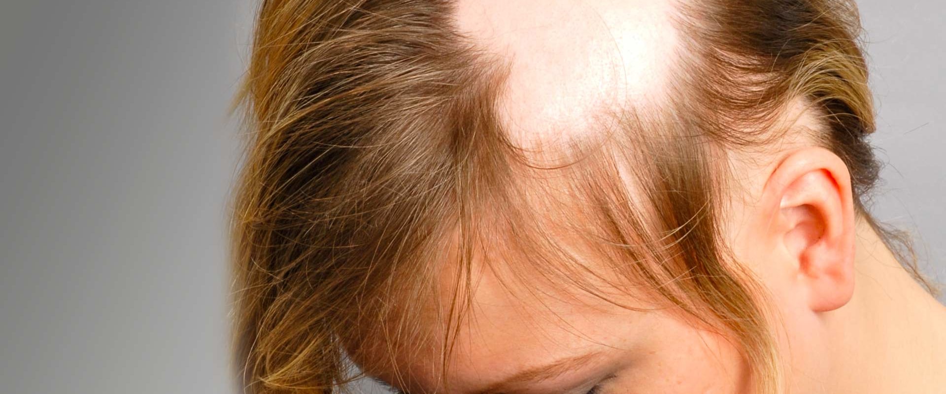 Understanding Alopecia