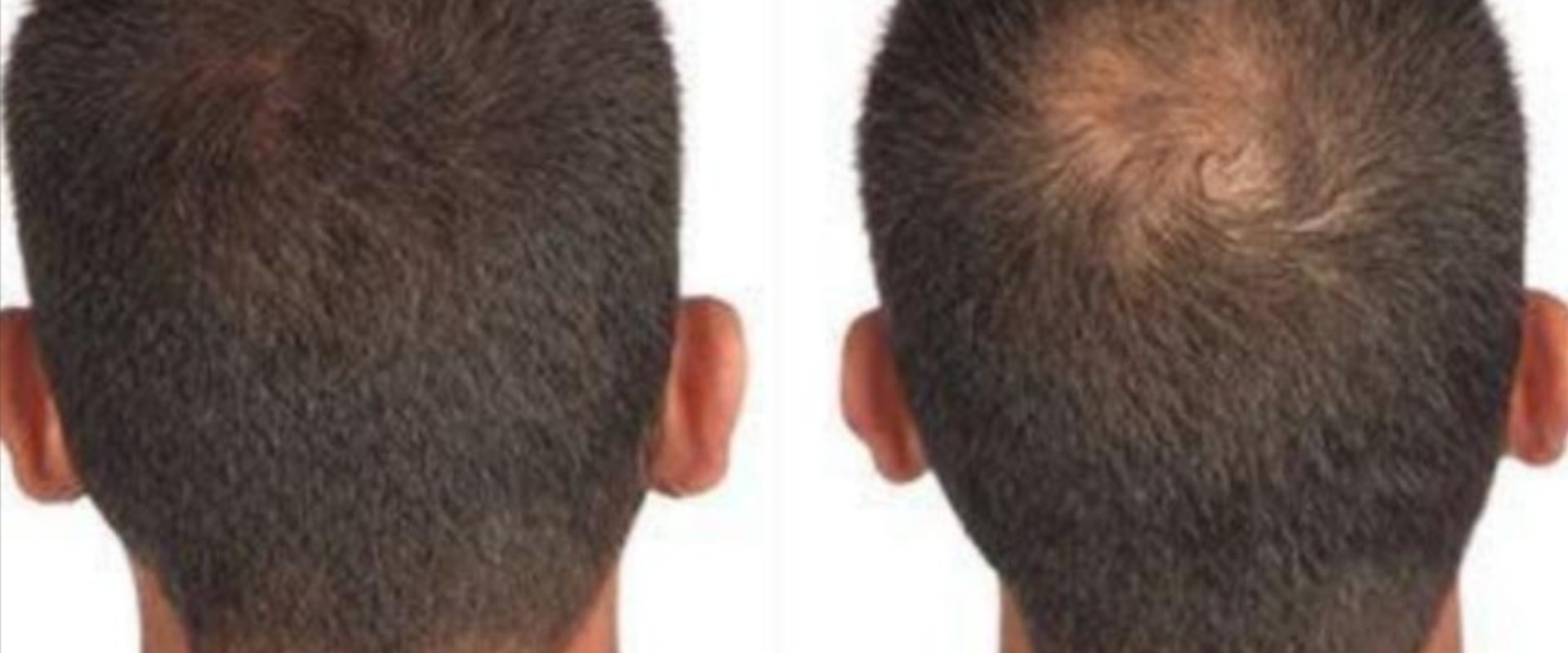 A Comprehensive Overview of Hair Fibers for Hair Restoration and Hair Loss Concealers