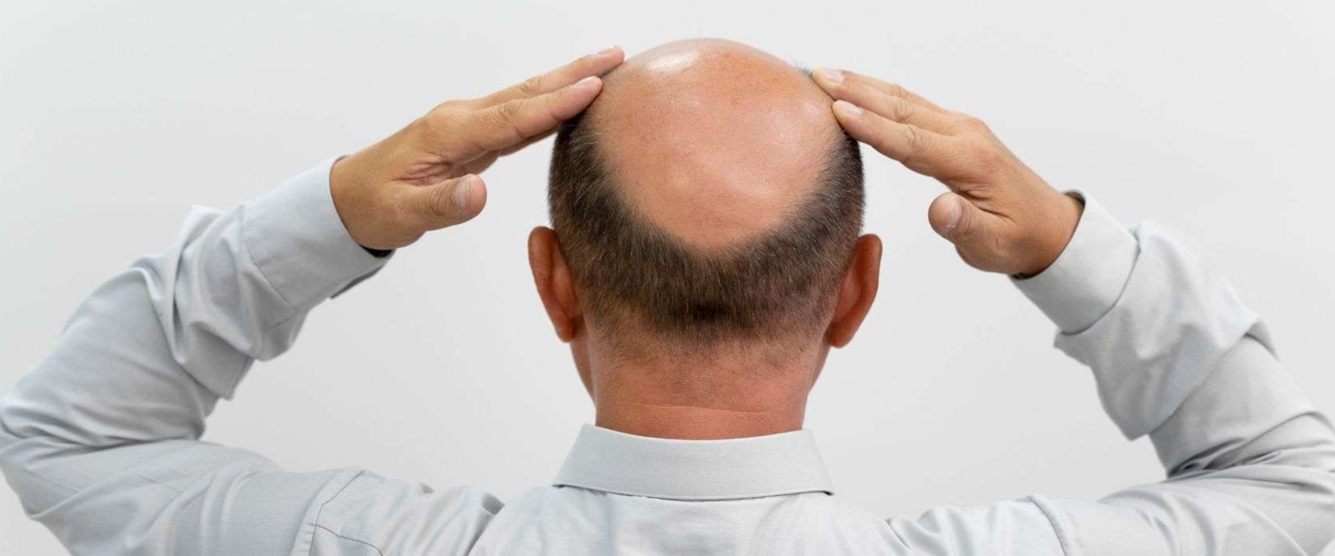 Understanding the Connection Between Lifestyle Factors and Male Pattern Baldness