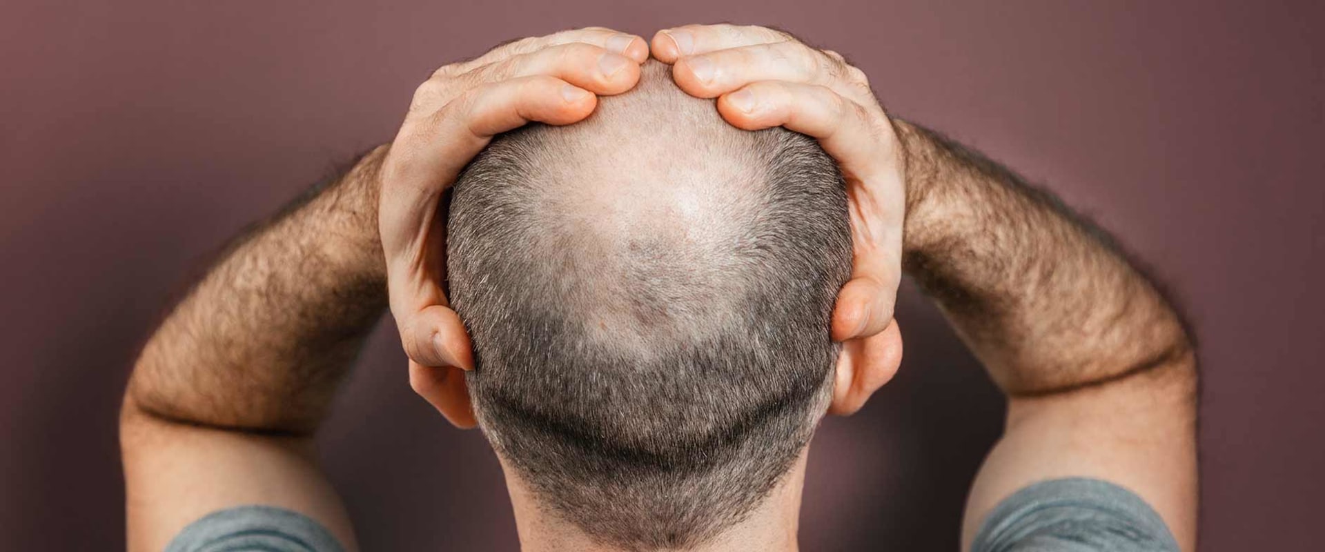 The Truth About Genetics and Male Pattern Baldness