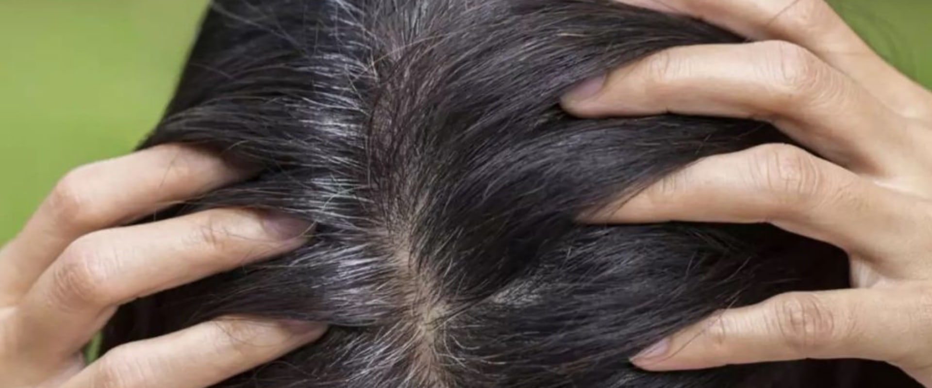 Understanding Iron-Deficiency Anemia and Hair Loss