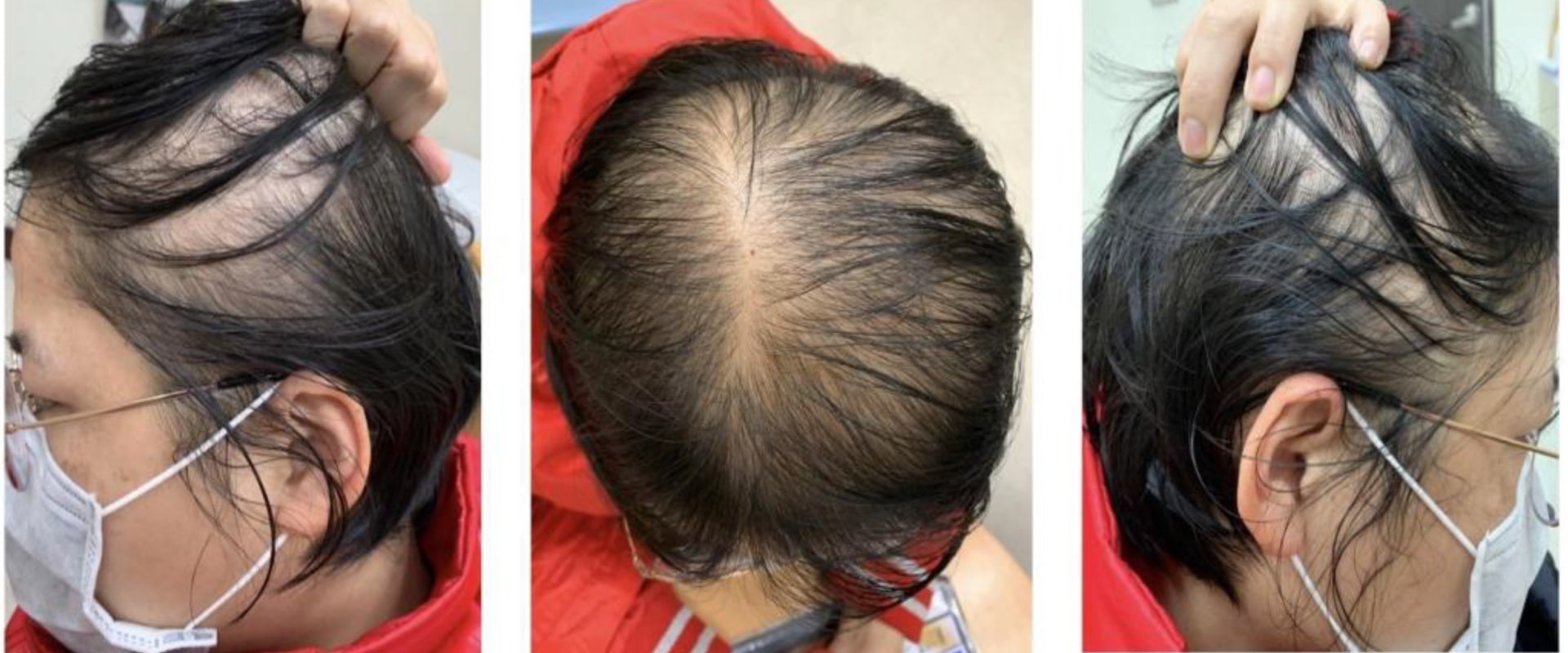 Understanding Female Pattern Hair Loss: Causes and Genetics