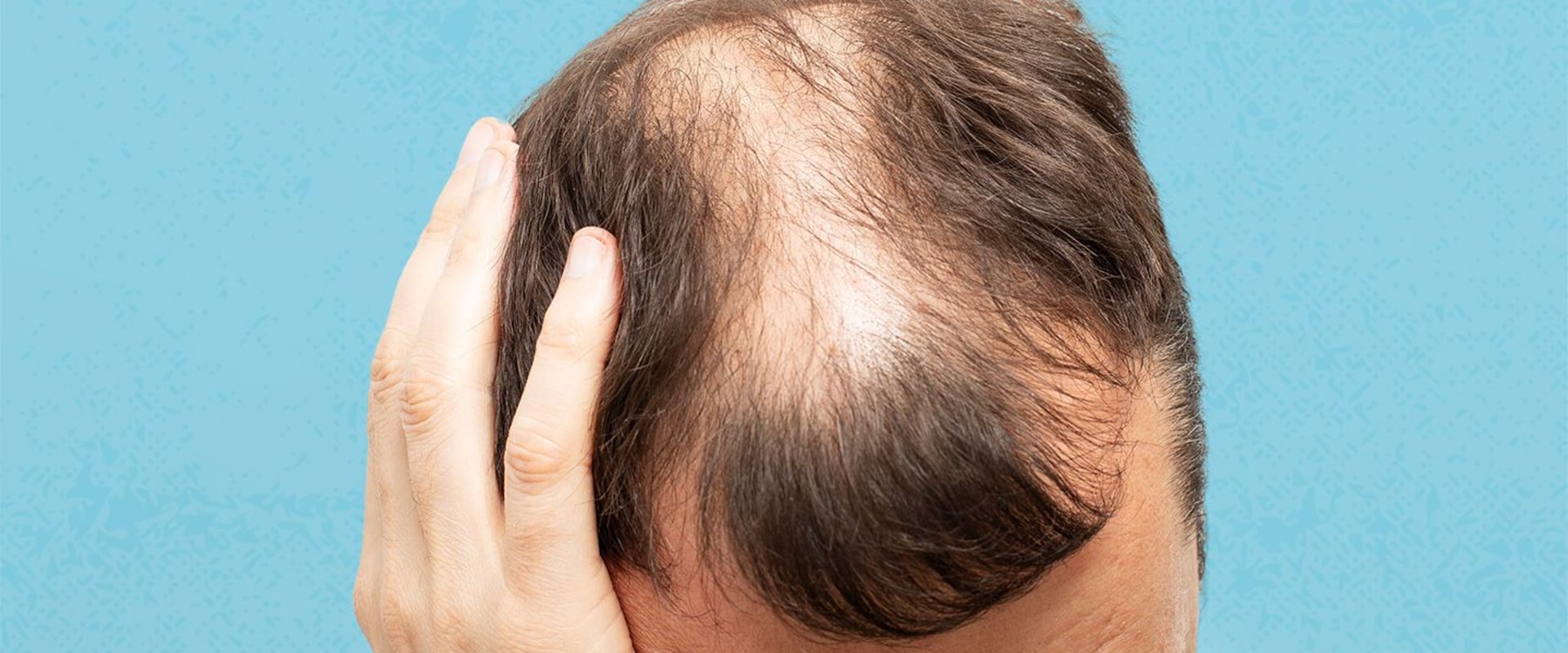 Lifestyle Factors and Female Hair Loss: Understanding the Causes and Risks