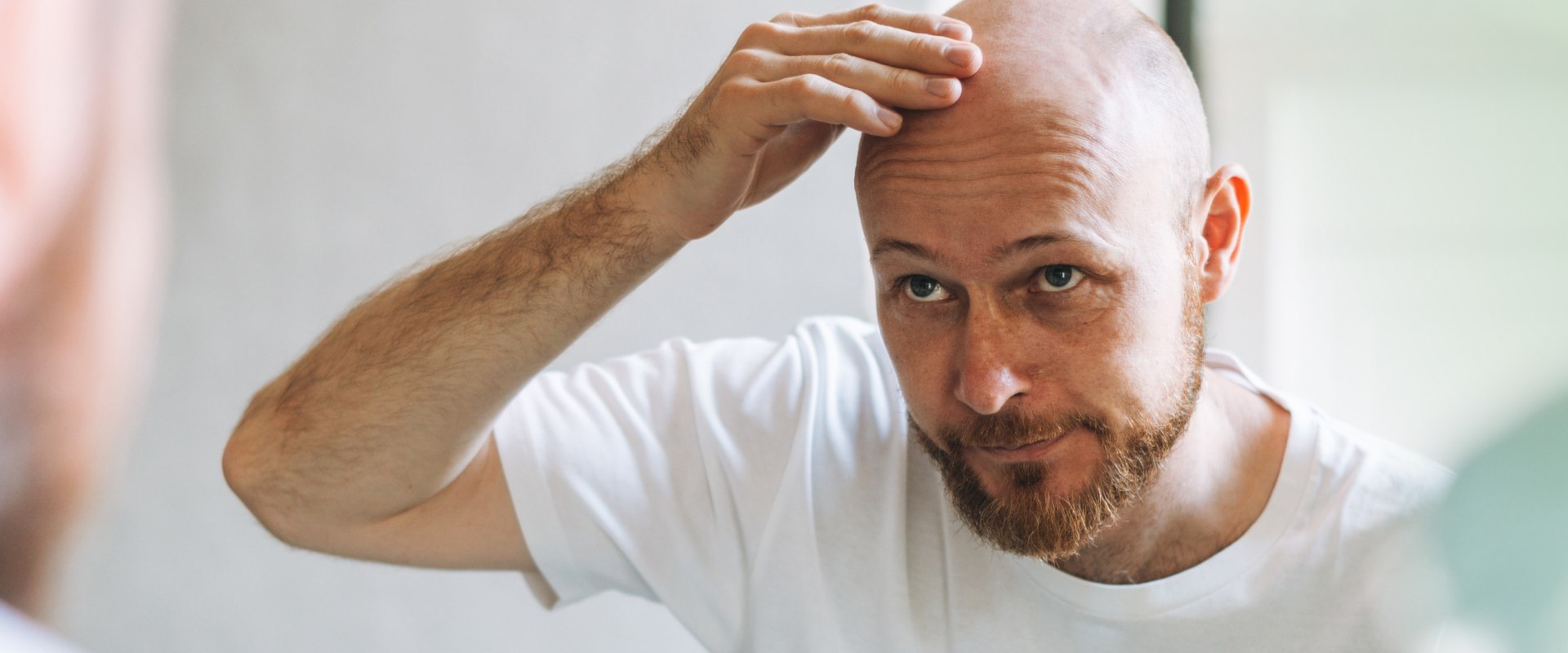 Understanding Male Pattern Baldness: Causes, Genetics, and Solutions