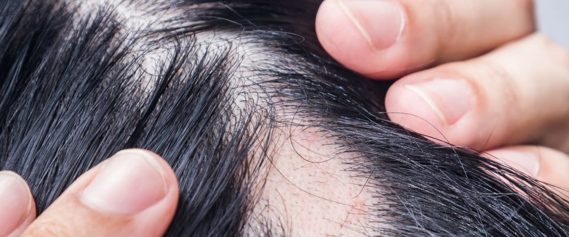 Understanding Medical Conditions and Female Hair Loss