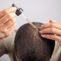 All You Need to Know About Minoxidil: A Comprehensive Guide for Hair Loss Treatment