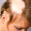 Understanding Alopecia