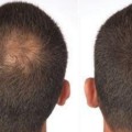 A Comprehensive Overview of Hair Fibers for Hair Restoration and Hair Loss Concealers