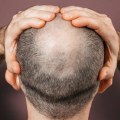 The Truth About Genetics and Male Pattern Baldness