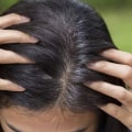 Understanding Iron-Deficiency Anemia and Hair Loss