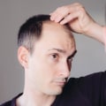 Lifestyle Changes for Preventing Male Pattern Baldness