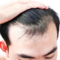 Understanding the Link Between Stress and Hair Loss