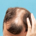 Lifestyle Factors and Female Hair Loss: Understanding the Causes and Risks