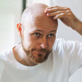 Understanding Male Pattern Baldness: Causes, Genetics, and Solutions