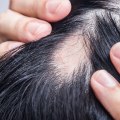 Understanding Medical Conditions and Female Hair Loss