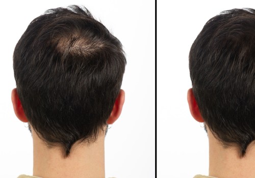 Understanding Finasteride: A Comprehensive Overview for Hair Loss Treatment