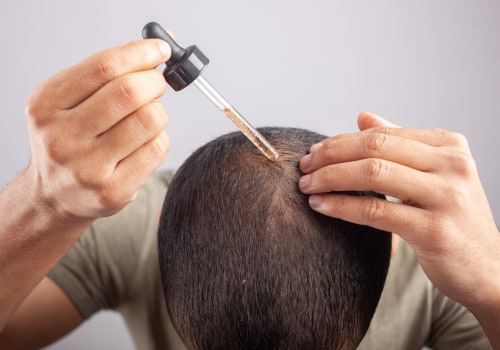 All You Need to Know About Minoxidil: A Comprehensive Guide for Hair Loss Treatment