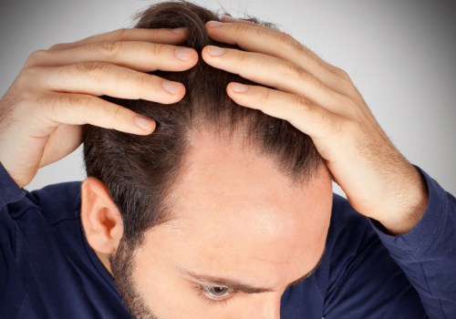 Hormonal Changes and Male Pattern Baldness: A Comprehensive Guide