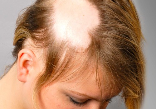 Understanding Alopecia