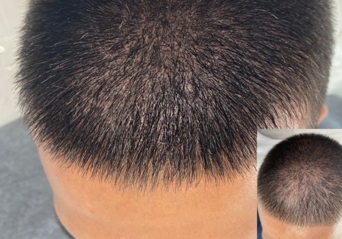 A Guide to Scalp Camouflage Techniques for Hair Loss