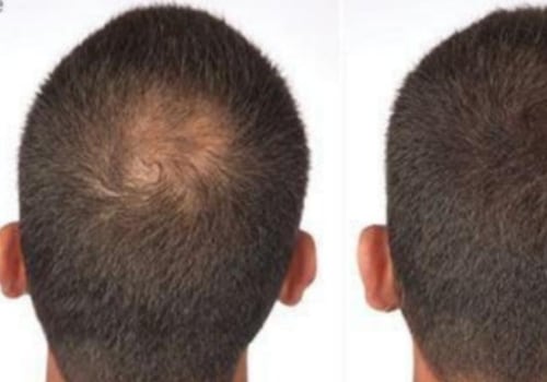 A Comprehensive Overview of Hair Fibers for Hair Restoration and Hair Loss Concealers