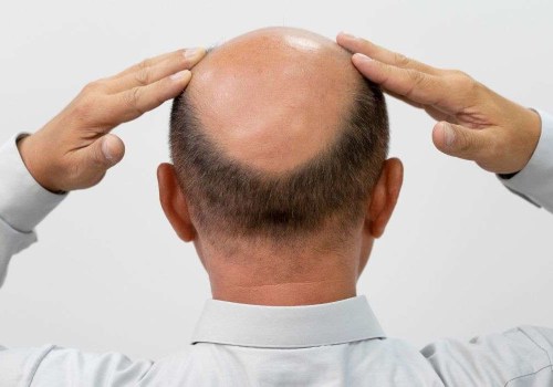 Understanding the Connection Between Lifestyle Factors and Male Pattern Baldness