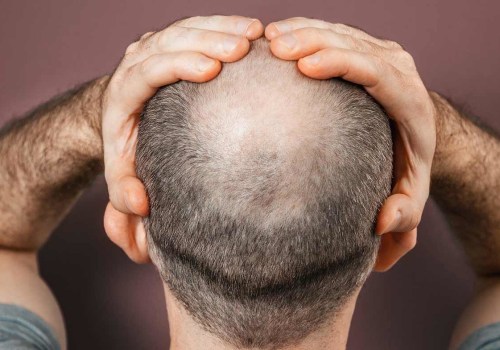 The Truth About Genetics and Male Pattern Baldness