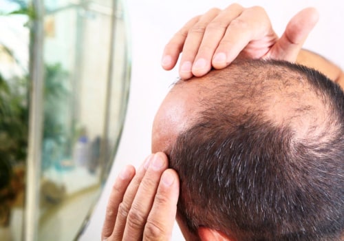 How to Diagnose and Treat Male Pattern Baldness