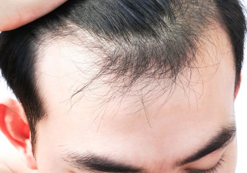 Understanding the Link Between Stress and Hair Loss