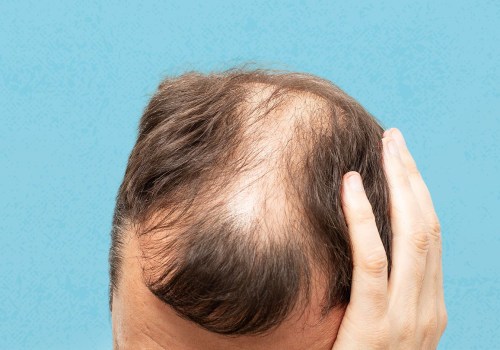 Lifestyle Factors and Female Hair Loss: Understanding the Causes and Risks