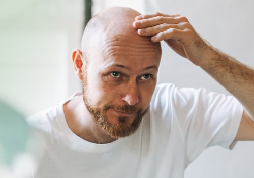 Understanding Male Pattern Baldness: Causes, Genetics, and Solutions