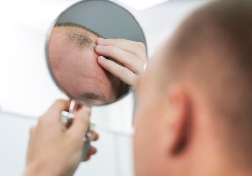 A Comprehensive Look at Hair Transplants