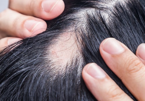 Understanding Medical Conditions and Female Hair Loss